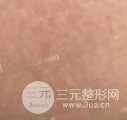 果酸換膚去妊娠紋真人案例和妊娠紋整形手術(shù)前后對比圖