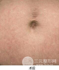 果酸換膚去妊娠紋真人案例和妊娠紋整形手術(shù)前后對(duì)比圖