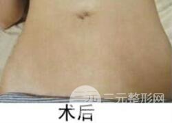 如何去除妊娠紋？做了果酸換膚去妊娠紋果不錯，真人案例圖片分享