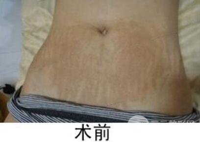 如何去除妊娠紋?做了果酸換膚去妊娠紋果不錯,真人案例圖片分享