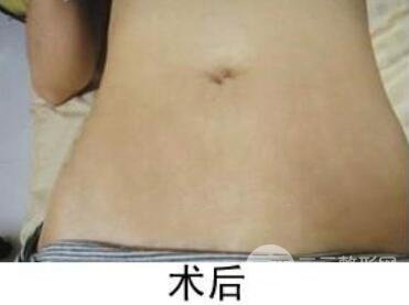 如何去除妊娠紋?做了果酸換膚去妊娠紋果不錯,真人案例圖片分享