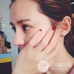 隆鼻整形多少錢 李圣利隆鼻整形案例