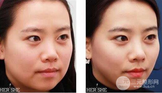面部吸脂大概要多少錢？面部吸脂減肥價(jià)格表和前后果圖片