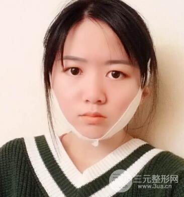怎樣減掉雙下巴?雙下巴吸脂后個人經(jīng)歷 價格略貴但果好