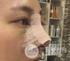 耳軟骨墊鼻尖+假體隆鼻恢復過程實例和價格圖片分享