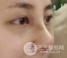 耳軟骨墊鼻尖+假體隆鼻恢復過程實例和價格圖片分享
