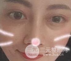 耳軟骨墊鼻尖+假體隆鼻恢復過程實例和價格圖片分享