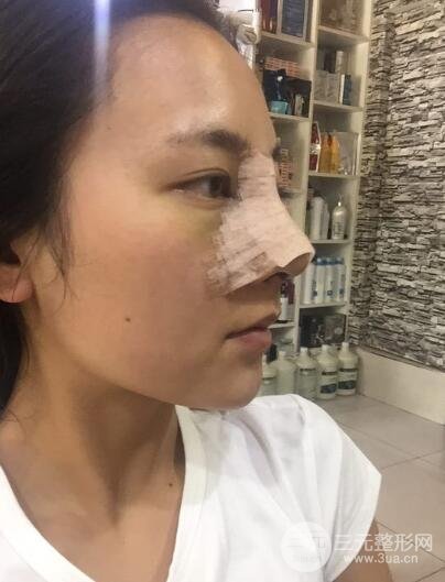 耳軟骨墊鼻尖+假體隆鼻恢復(fù)過(guò)程實(shí)例和價(jià)格圖片分享
