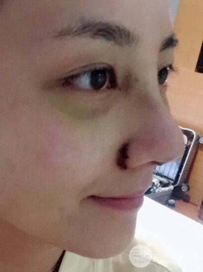 耳軟骨墊鼻尖+假體隆鼻恢復(fù)過(guò)程實(shí)例和價(jià)格圖片分享