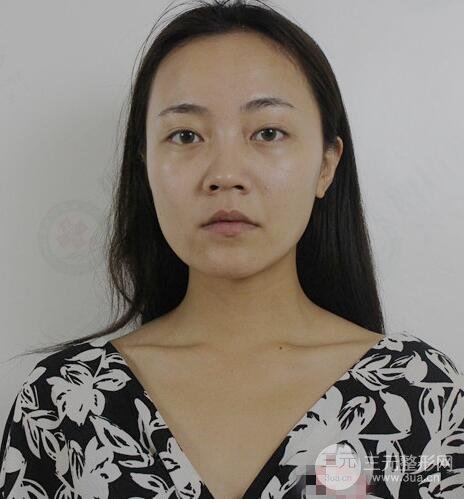 耳軟骨墊鼻尖+假體隆鼻恢復(fù)過(guò)程實(shí)例和價(jià)格圖片分享