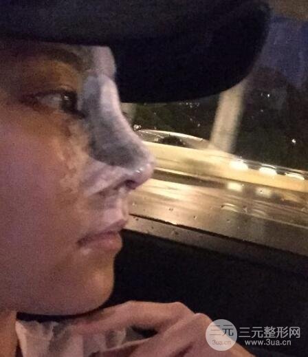 耳軟骨墊鼻尖+假體隆鼻恢復(fù)過(guò)程實(shí)例和價(jià)格圖片分享