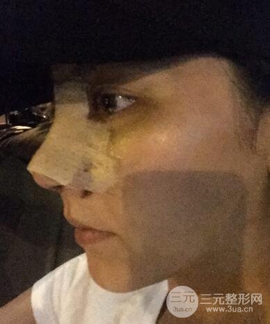 耳軟骨墊鼻尖+假體隆鼻恢復(fù)過(guò)程實(shí)例和價(jià)格圖片分享