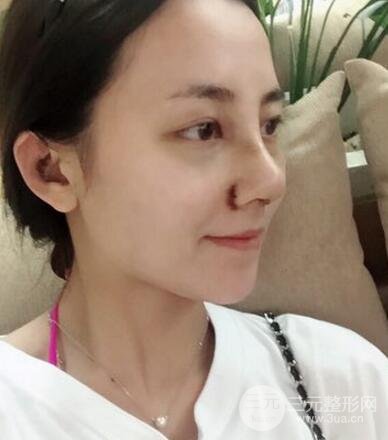 耳軟骨墊鼻尖+假體隆鼻恢復(fù)過(guò)程實(shí)例和價(jià)格圖片分享