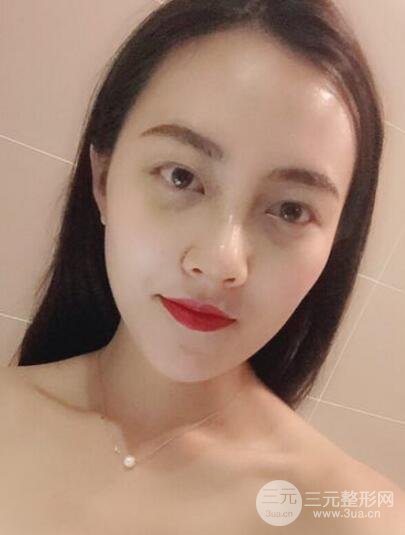 耳軟骨墊鼻尖+假體隆鼻恢復(fù)過(guò)程實(shí)例和價(jià)格圖片分享