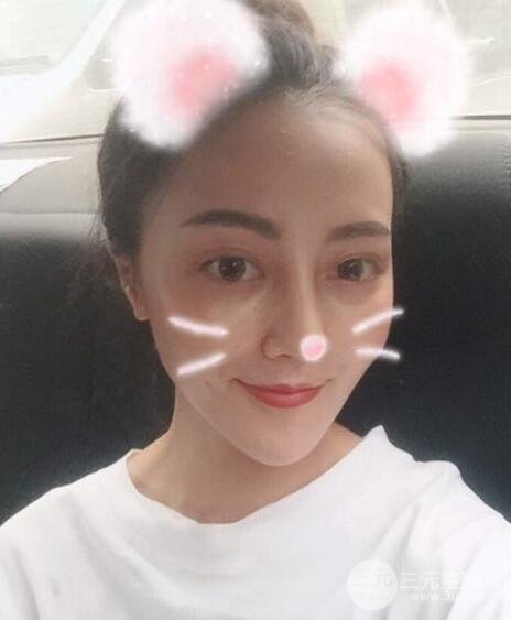 耳軟骨墊鼻尖+假體隆鼻恢復(fù)過(guò)程實(shí)例和價(jià)格圖片分享