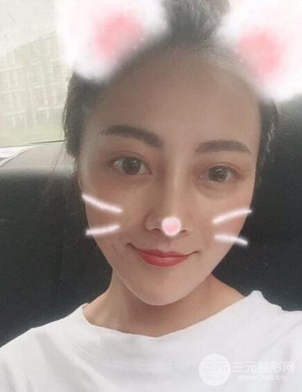 耳軟骨墊鼻尖+假體隆鼻恢復(fù)過(guò)程實(shí)例和價(jià)格圖片分享