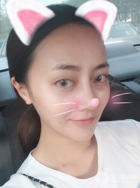 耳軟骨墊鼻尖+假體隆鼻恢復(fù)過(guò)程實(shí)例和價(jià)格圖片分享