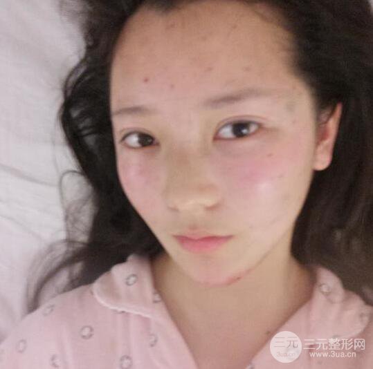 長得太著急是怎樣一種體驗？妹子血淚分享自體脂肪填充詳細(xì)部年輕化經(jīng)驗