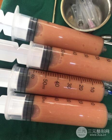 自體脂肪面部填充價位和案例