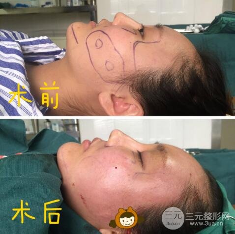 自體脂肪面部填充價位和案例