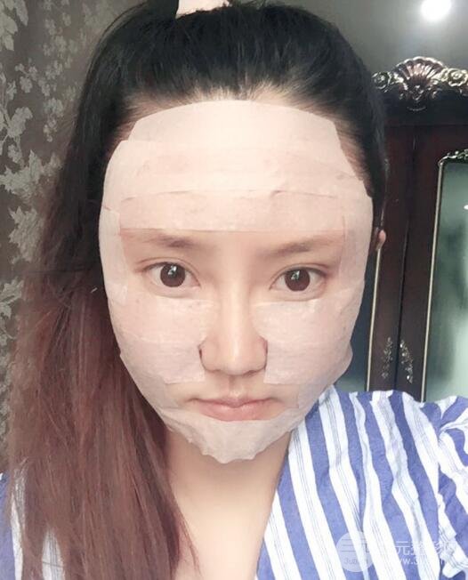 自體脂肪面部填充價位和案例