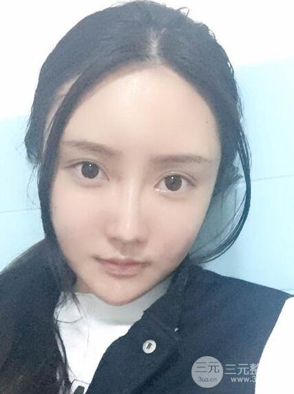 自體脂肪面部填充價位和案例