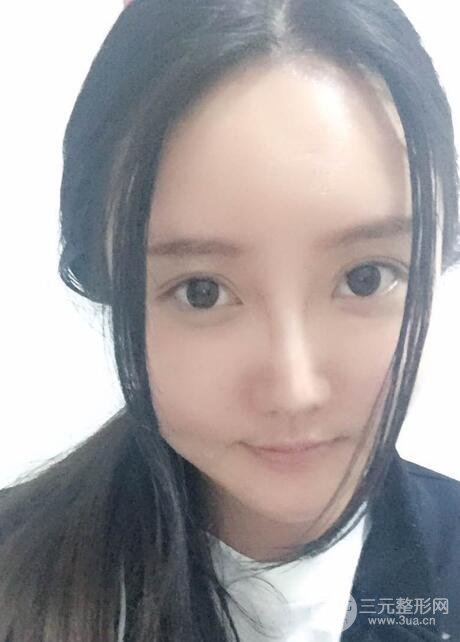 自體脂肪面部填充價位和案例