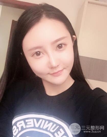 自體脂肪面部填充價位和案例