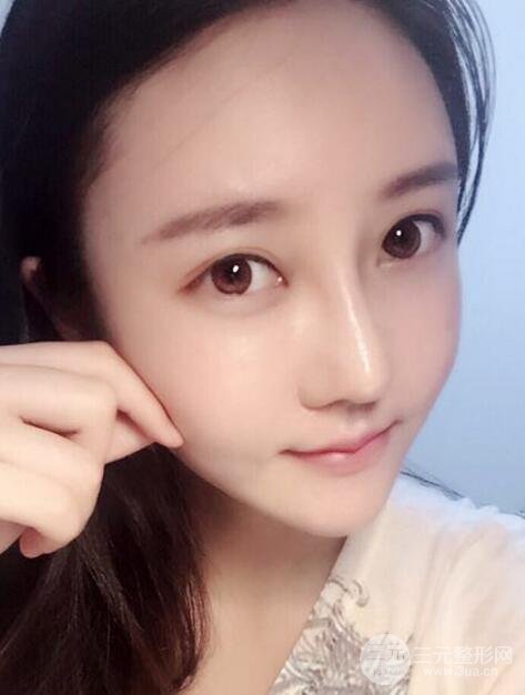 自體脂肪面部填充價位和案例