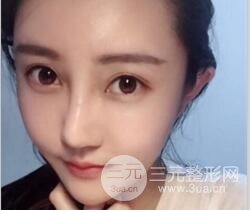 自體脂肪面部填充價位和案例