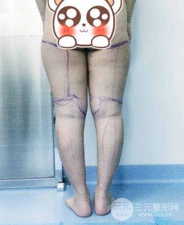 抽脂瘦腿價(jià)格和親身經(jīng)歷圖