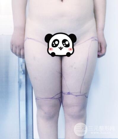 抽脂瘦腿價(jià)格和親身經(jīng)歷圖
