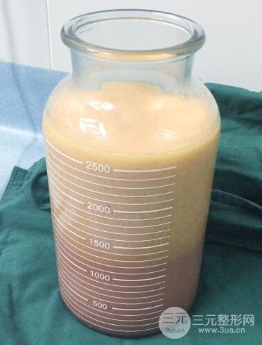 抽脂瘦腿價(jià)格和親身經(jīng)歷圖