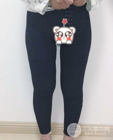 抽脂瘦腿價(jià)格和親身經(jīng)歷圖