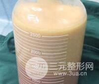 抽脂瘦腿價格和親身經(jīng)歷圖