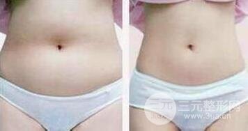 有的懶人減肥法是吸脂減肥【價(jià)格】