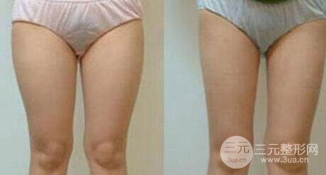 有的懶人減肥法是吸脂減肥【價(jià)格】