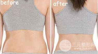 有的懶人減肥法是吸脂減肥【價(jià)格】