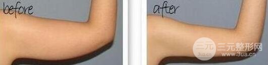 有的懶人減肥法是吸脂減肥【價(jià)格】