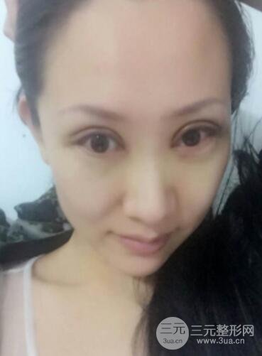 雙眼皮修復術價錢和案例圖