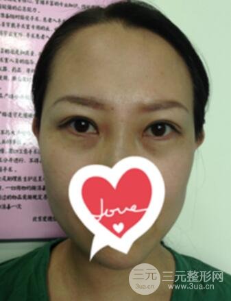 雙眼皮修復術價錢和案例圖