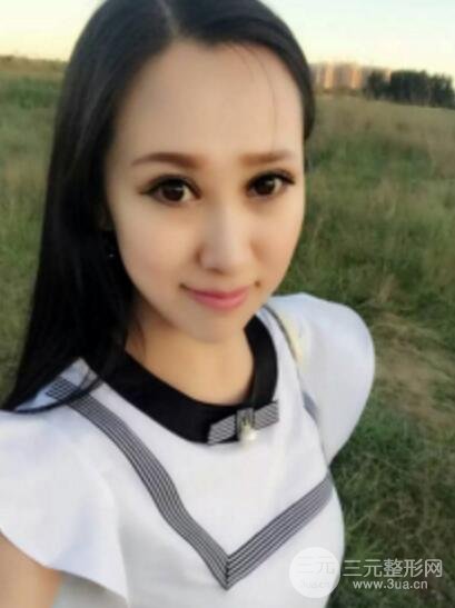 雙眼皮修復術價錢和案例圖