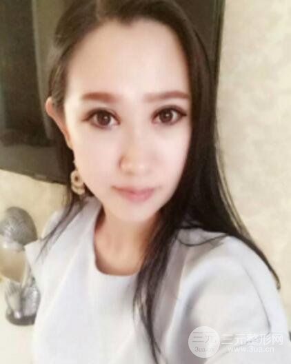 雙眼皮修復術價錢和案例圖