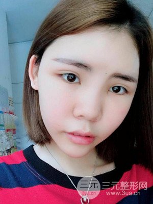 自體脂肪填充全臉真實(shí)案例——濟(jì)南愛容張慶國(guó)醫(yī)生做的