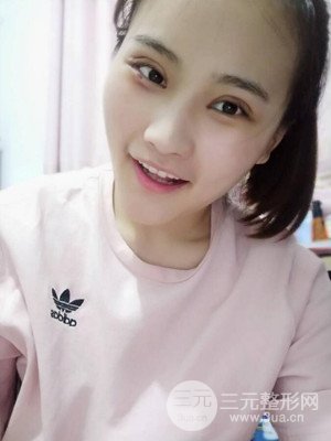 雙眼皮多項整形整形案例以及前后對比圖分享——濟南愛容路傳燕醫(yī)生做的~