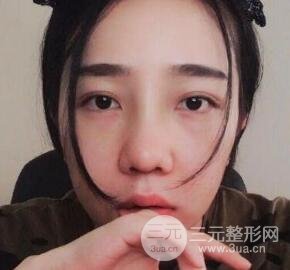 隆鼻整形價(jià)格和真人案例