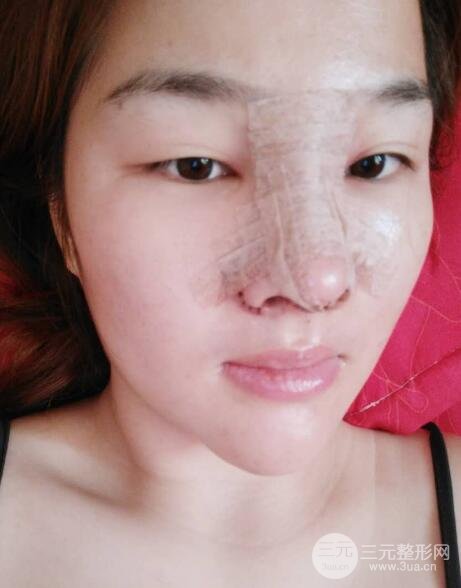 蒜頭鼻整形價格和對比照片案例