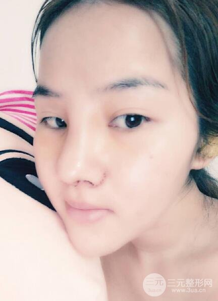 蒜頭鼻整形價格和對比照片案例