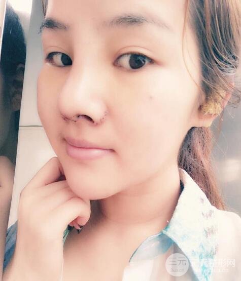 蒜頭鼻整形價格和對比照片案例