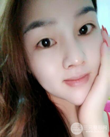 蒜頭鼻整形價格和對比照片案例